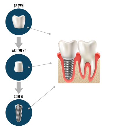 Dental Implants in Clinton Township
